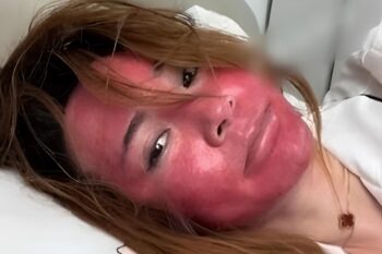 Da mặt đỏ lựng bất thường vì 22 năm không tẩy trang-ongkinh