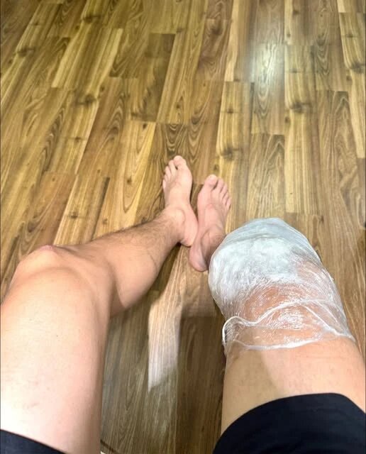 Phiên bản báo chí trung lập: Nam diễn viên VFC gặp biến chứng sau 1 năm đứt dây chằng chéo trước, tình trạng sức khỏe đáng lo ngại