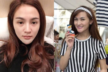 Mỹ nhân Việt phẫu thuật hỏng, suýt phải bỏ cằm do hoại tử