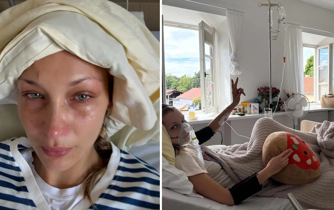 Bella Hadid nhập viện vì bệnh Lyme - Ongkinh