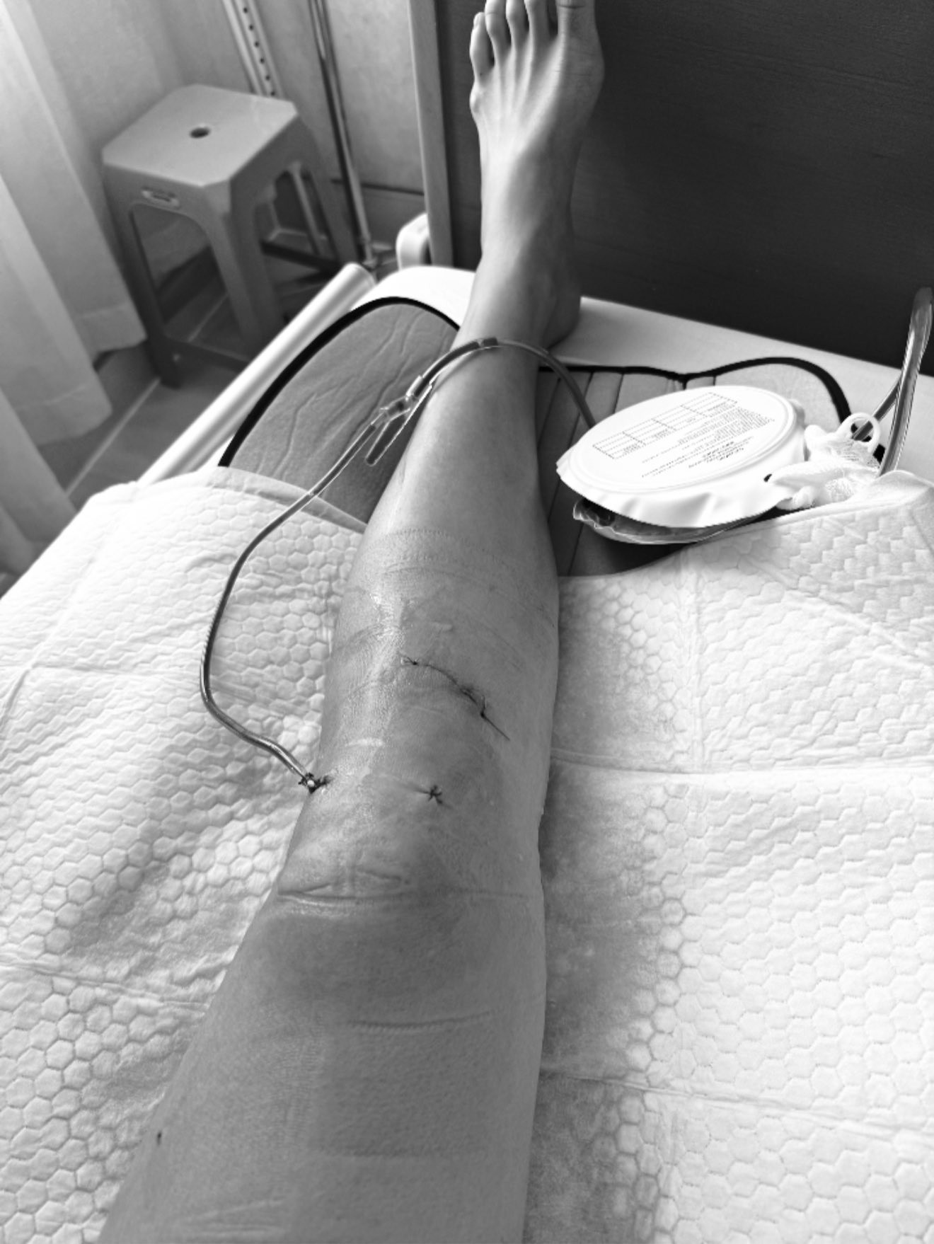 Minh Tú đứt hoàn toàn dây chằng gối khi tham gia Sao nhập ngũ